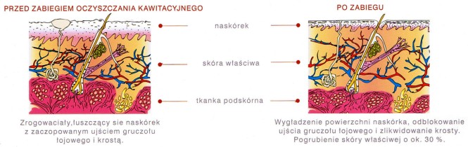 Peeling kawitacyjny - zalety stosowania